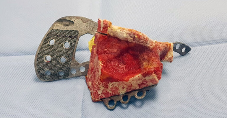 Oncological hip case 2019 performed with Smartbone On demand